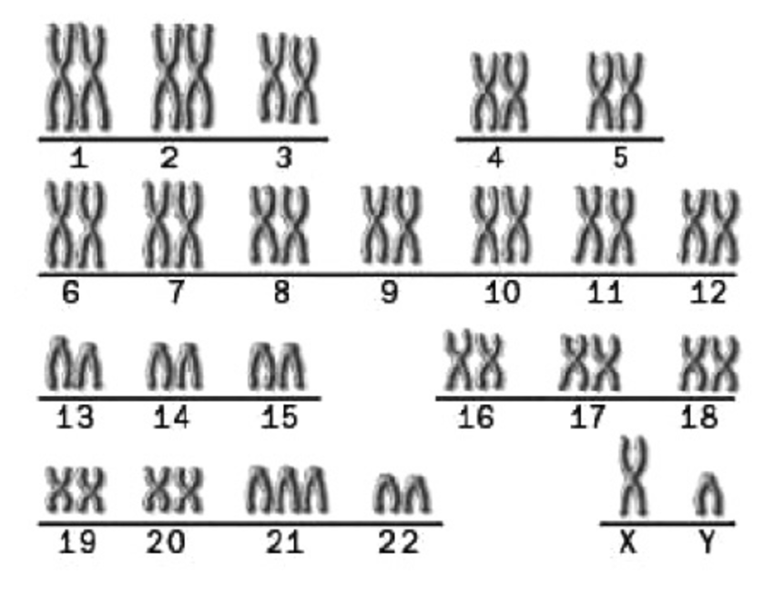 Trisomy 21 karyotype